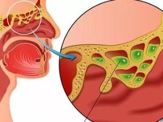 慢性化脓性鼻窦炎